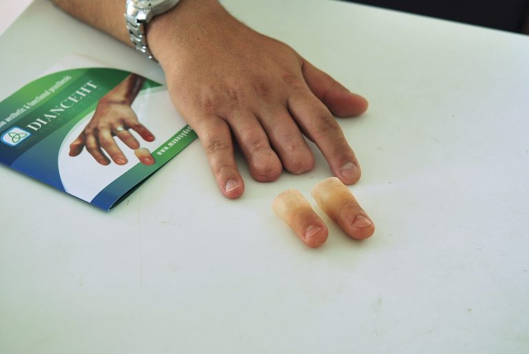 finger prosthesis