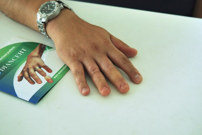 finger prostheses