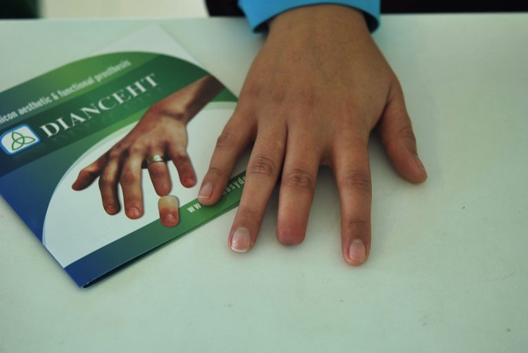 prosthetic middle finger