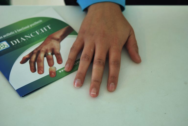 prosthetic fingers