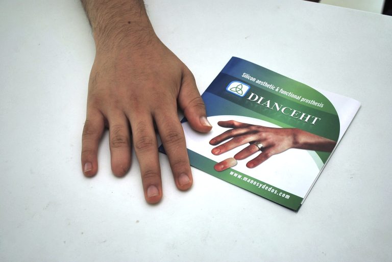 ring finger prostheses