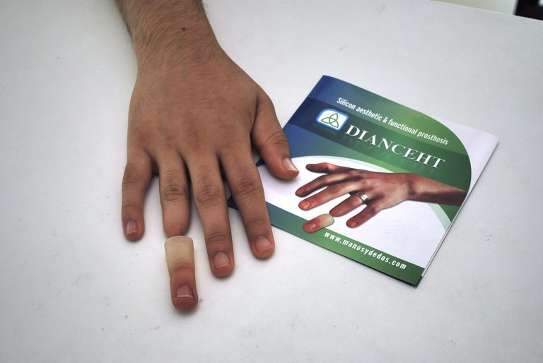 ring finger prosthesis