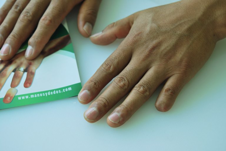 prosthetic pinky finger