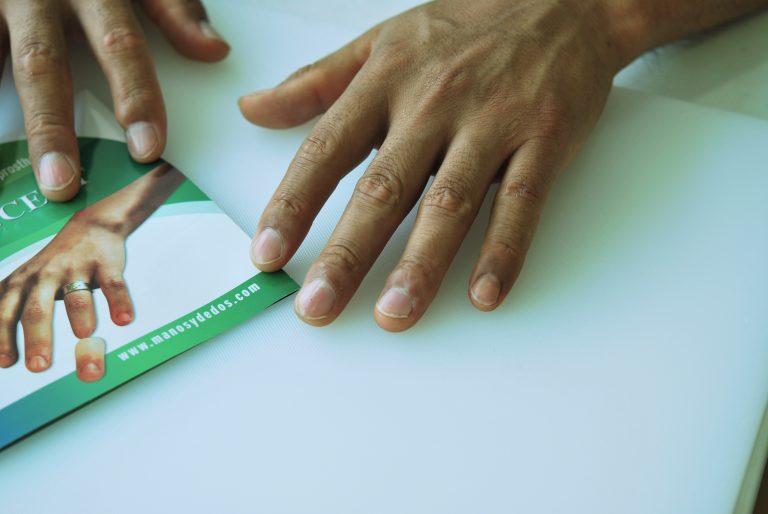 prosthetic finger