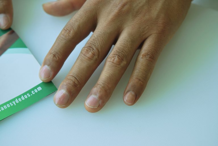 prosthetic finger pinky