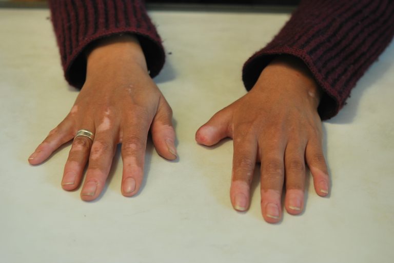 prosthetic fingers
