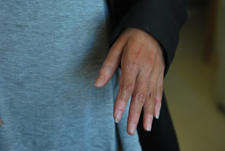 prosthetic finger