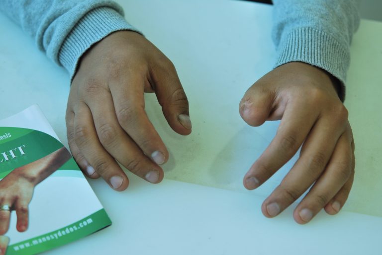 finger prosthesis