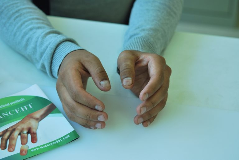finger prosthesis