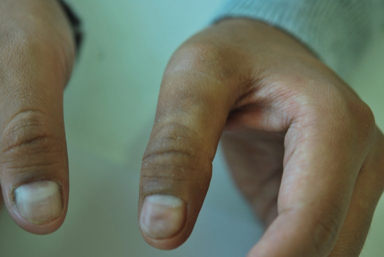 prosthetic fingers