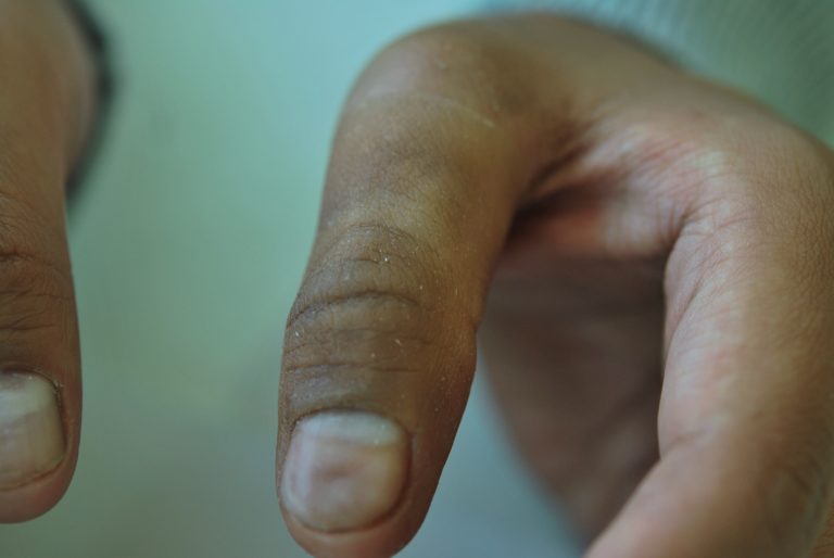 prosthetic finger