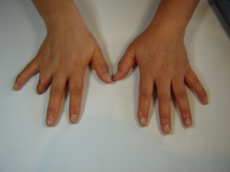 prosthetic finger