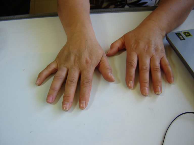 prosthetic finger