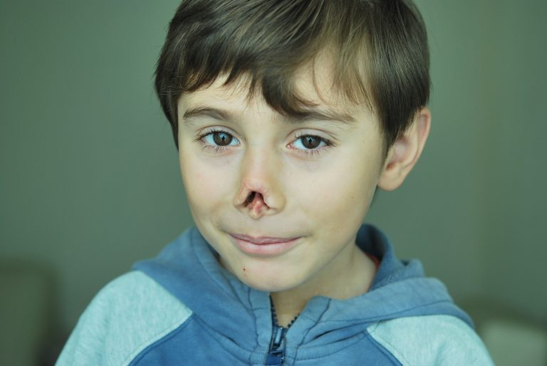 nose prosthetic